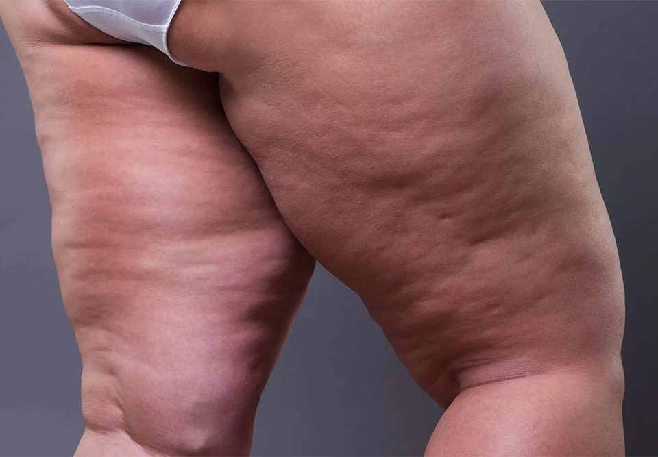 Conheça os Benefícios da Drenagem Linfática no Tratamento do Lipedema